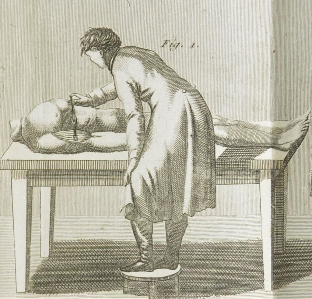 Dr Frankenstein: French Aldini